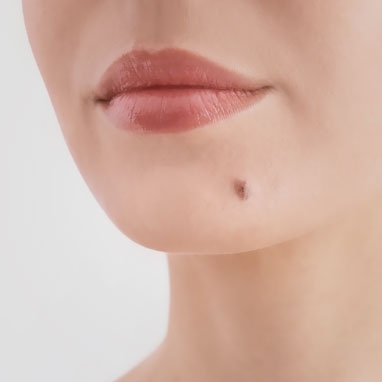 Removal of Mole on the Face and Neck Area